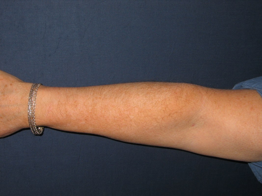 rechterarm vitiligo na